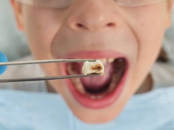 Best Dental Abscess Treatment in Ypsilanti, MI